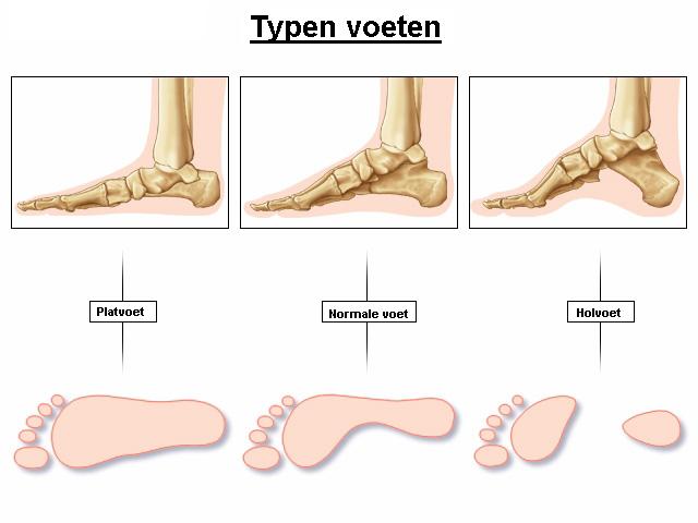 Voorbeeldschets voettypen Podotherapie Couteaux